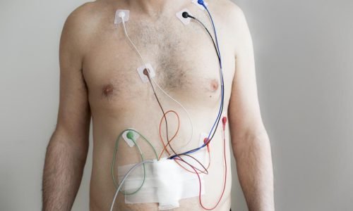 Holter Monitoring